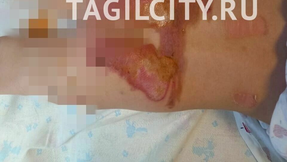 Двухлетнюю девочку с ожогами выписали из больницы Нижнего Тагила