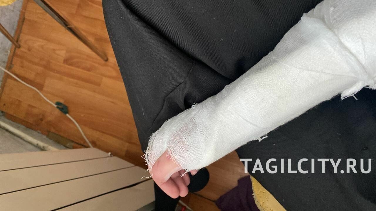 Тагильчанка сломала руку, поскользнувшись на льду возле дома