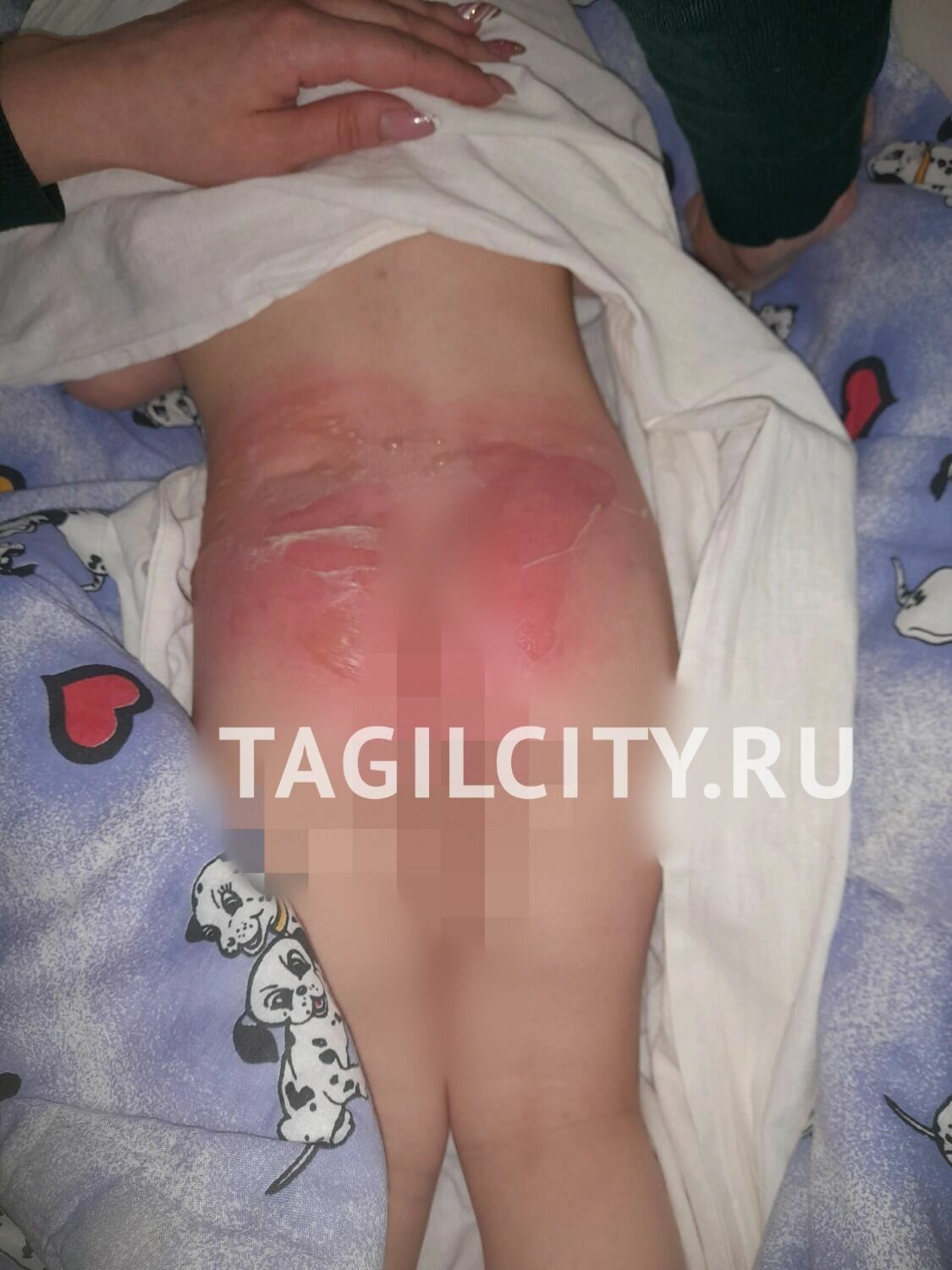 Ребенок получил ожоги в детском саду Нижнего Тагила